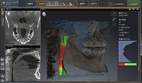 閉塞性睡眠時無呼吸症(OSA)治療について