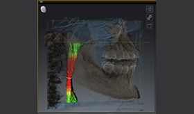 閉塞性睡眠時無呼吸症(OSA)治療について