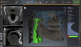 閉塞性睡眠時無呼吸症(OSA)治療について